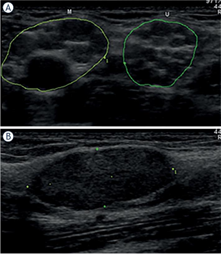 (A) Transverse ultrasonographic (US) view of the median (M) and ulnar (U) nerve in the axillary region showing numerous globular hypoechoic peripheral nerve tumours (PNTs) causing largely increased nerve cross sectional areas (CSAs, 148 mm2 and 101 mm2, respectively). (B) Longitudinal view of a single partially encapsulated, slightly lobulated and rather homogenous oval PNT (length 24 mm, thickness 9 mm) with central, but poorly defined nerve-tumour transition.5 Most probably these numerous PNTs are neurofibromas, although diagnosis in this 52-year-old woman presenting with peripheral neuropathy, primary lymphedema, and history of mitral and aortic valve surgery (patient #13, Tables 2–3), is not known yet.