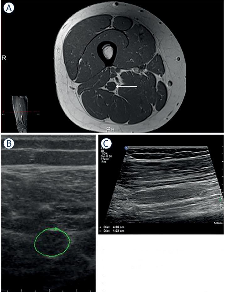 Comparison of transverse image of the sciatic peripheral nerve tumour (PNT) on (A) magnetic resonance (MR) T1 (arrow) and (B) ultrasonography (US). (C) Longitudinal US view of PNT in the middle thigh (A – small picture on the left), affecting the tibial portion of sciatic nerve. In this 22-year-old girl MR revealed at the exit of sciatic nerve from the pelvis another PNT affecting its fibular portion, and causing right foot drop of 14 years duration (patient #10, Tables 2–3). Based on clinical and imaging features in this patient diagnosis of probable perineurioma was made.