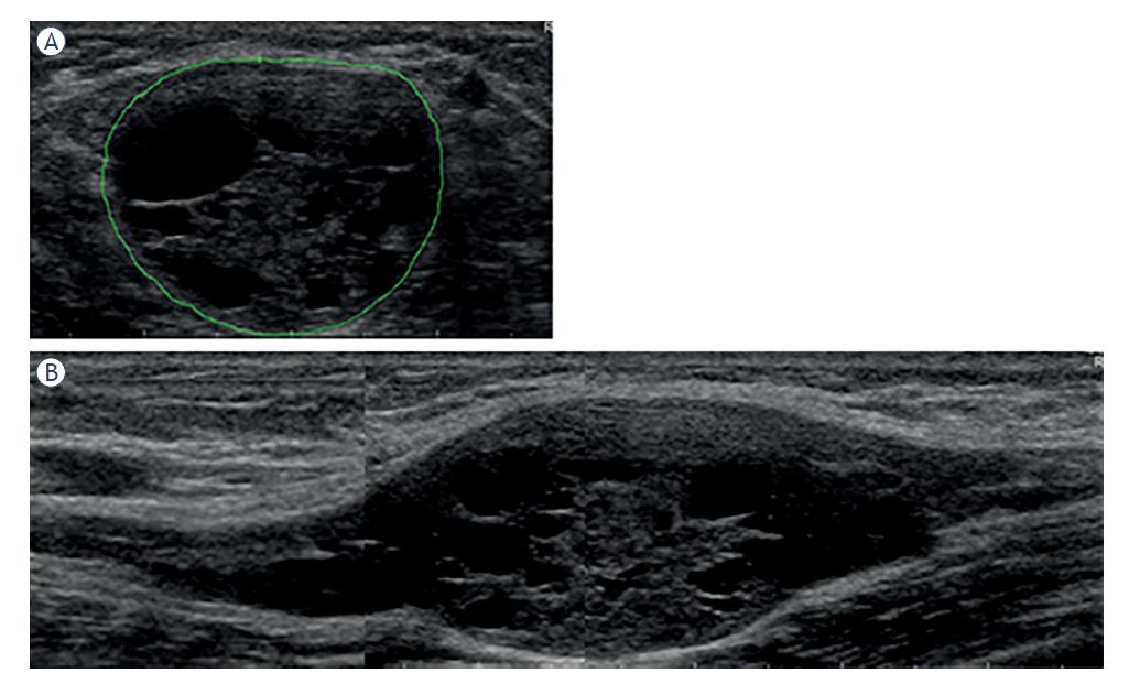(A) Transverse and (B) longitudinal ultrasonographic (US) view of a large peripheral nerve tumour (PNT) on the left ulnar nerve just above the elbow. Three years before this 47-year-old man noted a palpable mass that in the last 6 months on touching started to elicit electrisation spreading into the last two fingers (patient #8, Tables 2–3). Well encapsulated, slightly lobulated, predominantly cystic and highly heterogenous hypoechoic oval lesion with central and poorly defined nerve-tumour transition can be seen. Histological examination confirmed a diagnosis of schwannoma.