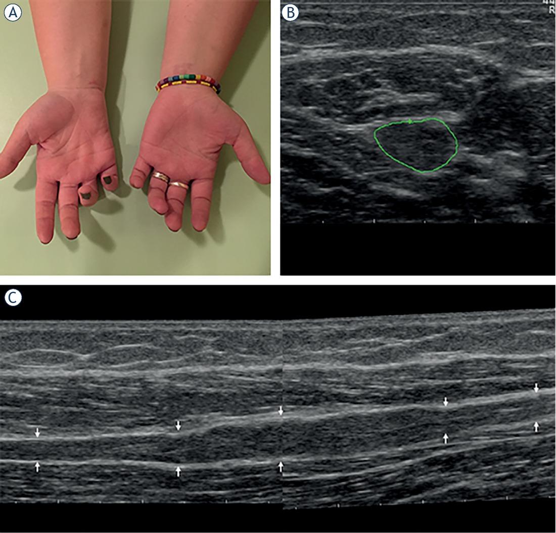 (A) Hands of a 26-year-old woman with 4-year history of muscle atrophy, weakness and numbness in the distal ulnar nerve territory (patient #5, Tables 2–3). Note intrinsic right palm muscle atrophy and clawing of the last two fingers. (B) On transverse ultrasonographic (US) view ulnar nerve cross sectional area (CSA) increased from 7 mm2 both proximally and distally to 20 mm2 in the middle of the lesion. (C) On longitudinal view a partially encapsulated, lobulated, fusiform hypoechoic right ulnar peripheral nerve tumour (PNT) of the forearm can be seen. Based on clinical and US features, we made a diagnosis of probable perineurioma.