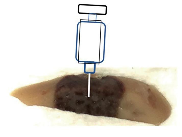 An illustration showing the implantation site in the liver. The dark area is the non-thermal irreversible electroporation (NTIRE) treated area.