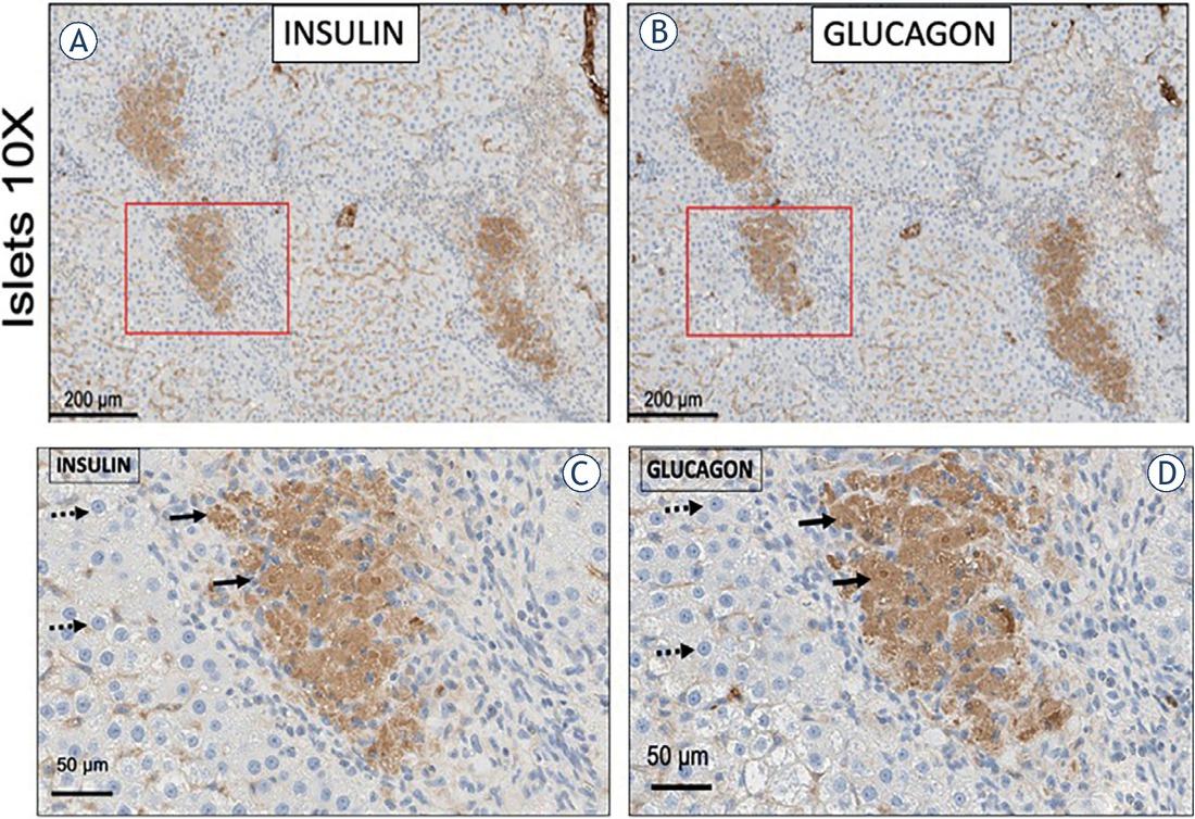 Liver tissue treated with non-thermal irreversible electroporation (NTIRE) and injected with 200 rat donor pancreatic islets. Seven days later, immunohistochemical staining was performed with anti-insulin and anti-glucagon antibodies (University of Texas at Houston, USA). In the pancreatic islets injected tissue, insulin-stained cell clusters are shown in (A) and (C) (full arrows). Normal hepatocytes were observed (dotted arrows) around the insulin-stained cells in the liver lobe. Glucagon-stained cells cluster are shown in (B) and (D) (full arrows). Normal hepatocytes were observed (dotted arrows) around the glucagon-stained cells in the liver lobe.