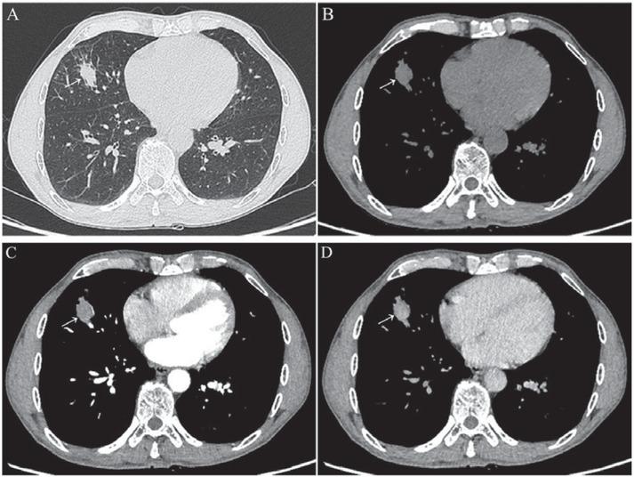 A solitary pulmonary nodule (SPN) with the size of 17.0 × 19.0 mm located in the middle lobe of right lung of a 59 years old male. Non-contrast enhanced CT (NECT), both upper (A) and (B) images, showed that there was sign of smooth margin, but without signs of lobulation, spiculation, vacuole, cavitation, air bronchogram, calcification, fat, pleural indentation, vessel convergence, or adjacent bronchial changes. Contrast enhanced CT (CECT) showed that there were mild and obvious enhancements in the arterial (C) and venous (D) phases, respectively. The patient was scanned with a CT-guided percutaneous lung biopsy procedure, and the pathological result showed chronic inflammatory disease. This SPN disappeared after a week of antibiotic therapy.