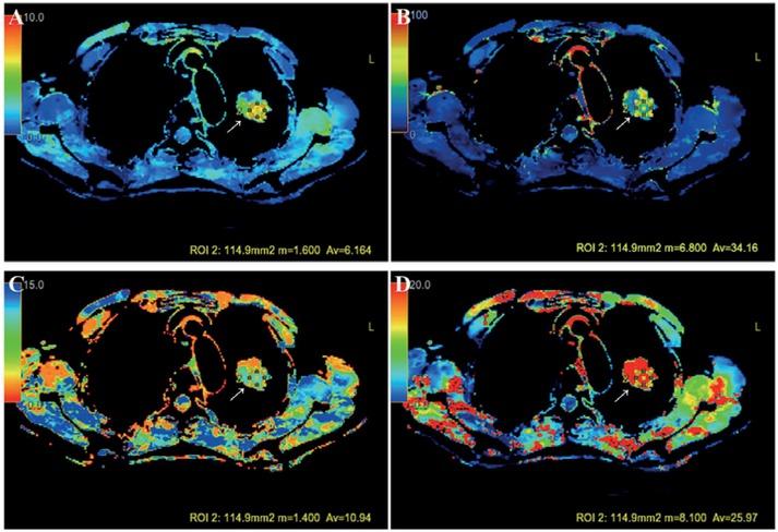 A solitary pulmonary nodule (SPN) with the size of 25.0 × 27.0 mm located in the superior lobe of left lung of a 61 years old female evaluated by CT perfusion imaging (CTPI). Blood volume (BV) (A), blood flow (BF) (B), mean transit time (MTT) (C), and permeability surface (PS) (D) for the SPN were 6.16 ml/100 g, 34.16 ml/100 g/min, 10.94 s, and 25.97 ml/100 g/min, respectively. Pathology of the SPN after the surgery confirmed the diagnosis of an adenocarcinoma.