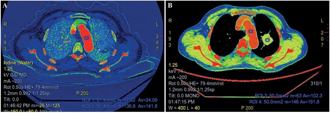 A solitary pulmonary nodule (SPN) with the size of 24.0 × 26.0 mm located in the superior lobe of left lung of a 57 years old female evaluated by arterial (A) and venous phases (B) of dual-energy CT (DECT). Iodine concentration at the arterial phase (aIC), Iodine concentration at the venous phase (vIC), normalized iodine concentration at the arterial phase (aNIC), and normalized iodine concentration at the venous phase (vNIC) were 2.409 mg/mL, 10.23 mg/mL, 0.17 (2.409/14.18), 0.53 (10.23/19.18) respectively. Pathology of the SPN after the surgery confirmed the diagnosis of an adenocarcinoma.