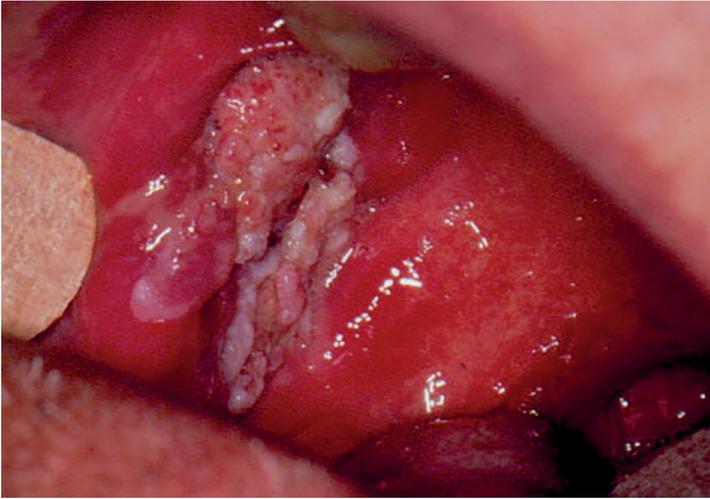 Verrucous carcinoma of the right buccal mucosa (clinical stage T2N0M0) in an 81-year-old male patient. He presented with a whitish exophytic tumour mass of the inner side of the right cheek and without suspicious lymph nodes on the neck. The lesion was noticed by the patient a month before initial examination, and it occasionally hurt, but he had no problems feeding. Due to associated diseases, he was treated with radiotherapy (55 Gy, 2.2 Gy/fraction) and concurrent intravenous chemotherapy (vinblastine 2 mg, day 1; methotrexate 50 mg, day 2; bleomycin 15 mg, days 2 and 3). The patient died of injury 5.5 years after completion of treatment for verrucous carcinoma with no evidence of malignant disease in oral cavity.