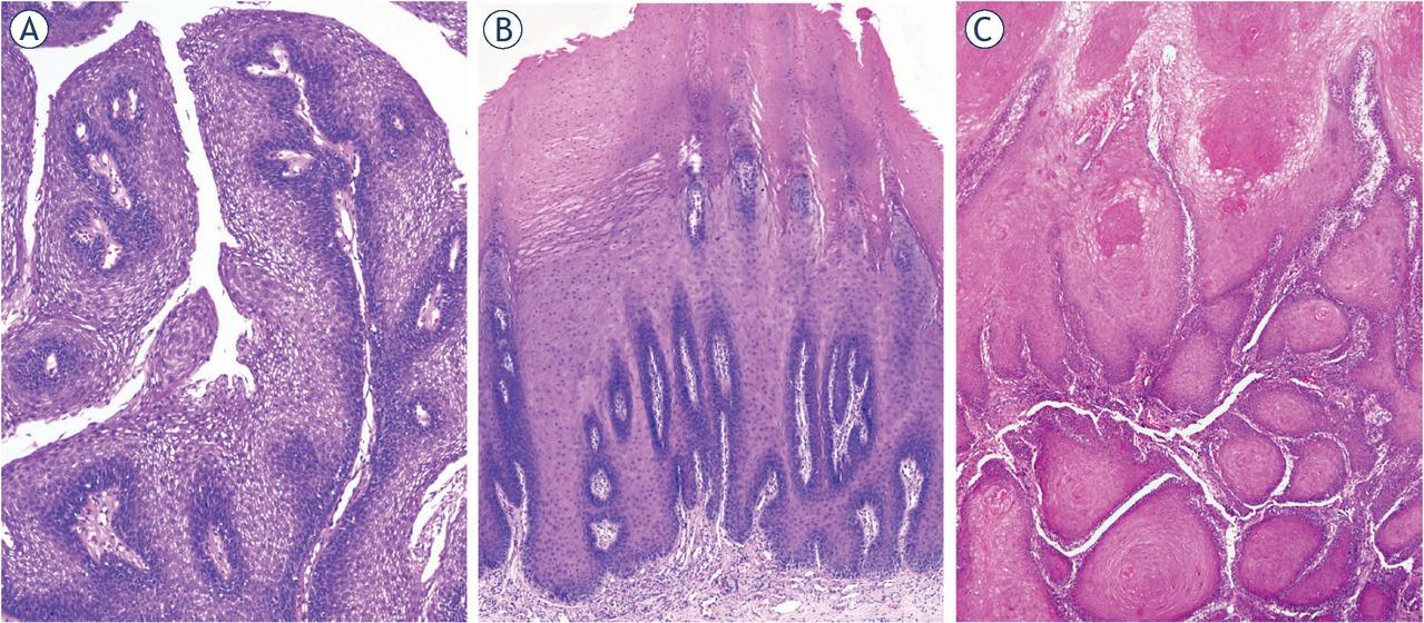 Histopathology images of oral verrucous lesions. Squamous cell papilloma (A) exophytic lesion, composed of finger-like projections, lined by non-keratinizing stratified squamous epithelium and a central connective tissue core. Verrucous hyperplasia (B) exophytic lesion, composed of hyperplastic keratinizing squamous epithelium with no invasion into the underlying stroma. Verrucous carcinoma (C) exophytic tumour, resembling verrucous hyperplasia, but with invasive growth, consisting of broad epithelial islands and processes, with no atypia, exhibiting a pushing-border into the underlying stroma.