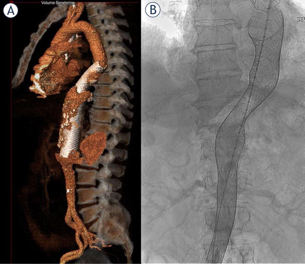 Volume rendering of implanted multilayer flow modulators (MFMs) (A) and fluoroscopic image of implanted MFM (B) in thoracoabdominal aorta.