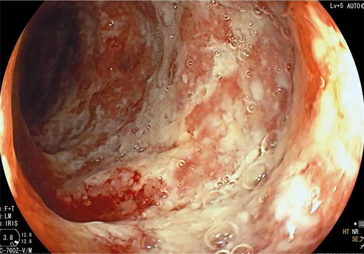 Endoscopic finding in case 2.
