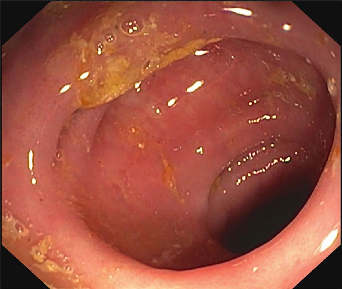 Endoscopic finding in case 3.