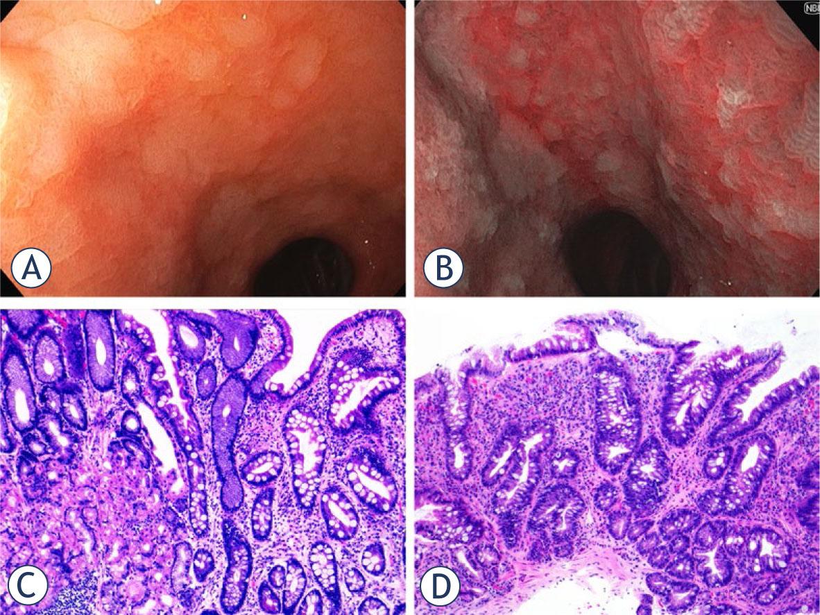 Gastric intestinal metaplasia, endoscopic (A, B) and histological (C, D) appearance. Gastric intestinal metaplasia is endoscopically characterized by the presence of grey-white velvety or slightly nodular elevated patches, which are clearly demarcated against the surrounding pink gastric mucosa, as illustrated in image A of antral gastric mucosa under white light. Narrow band imaging (NBI, depicted in image B) further enhances the visualization of mucosal and vascular patterns by employing optical filters to narrow the bandwidth of light. This technique offers superior contrast compared to white light endoscopy, thereby improving the detection of metaplastic transformation. Histologically, gastric intestinal metaplasia can be classified into either complete (as seen in image C) or incomplete types (as shown in image D). Image C demonstrates preserved oxyntic mucosa (on the left) adjacent to intestinal metaplasia of the complete type, which features enterocytes with a well-defined brush border, alongside well-formed goblet cells and Paneth cells. In contrast, image D illustrates the intestinal metaplasia of the gastric mucosa of the incomplete type, characterized by goblet cells of variable size and intervening mucin-secreting columnar cells that lack a brush border (both images are hematoxylin and eosin-stained, original magnification 10x).