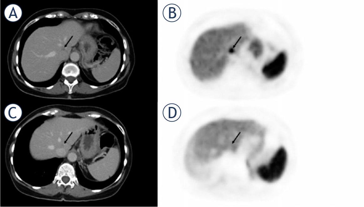 63-year-old female with responding liver metastasis of ileal neuroendocrine tumor. On the pretherapeutic PETCT (A, B) there were high tumor-to-liver (T/L) ratio. After three months of treatment with everolimus, the liver metastasis showed no significant shrinkage in size, but a significantly reduced uptake of 68Ga-DOTATATE (C, D) compared to pretherapeutic PET/CT (Tmax/Lmax: 0.94 vs. 2,09 and Tmean/Lmax 1.54 vs. 0.76).