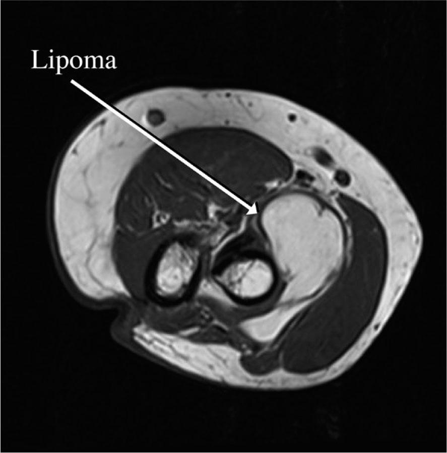 MRI of left elbow.