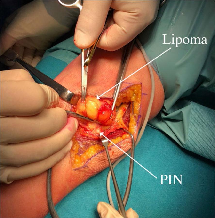 Lateral dissection along the common radial nerve and posterior interosseus nerve (PIN).