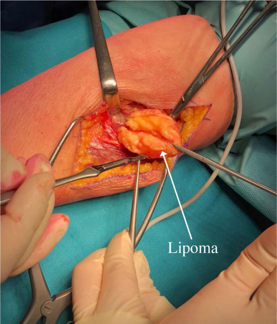 Medial dissection away from posterior interosseus nerve (PIN).