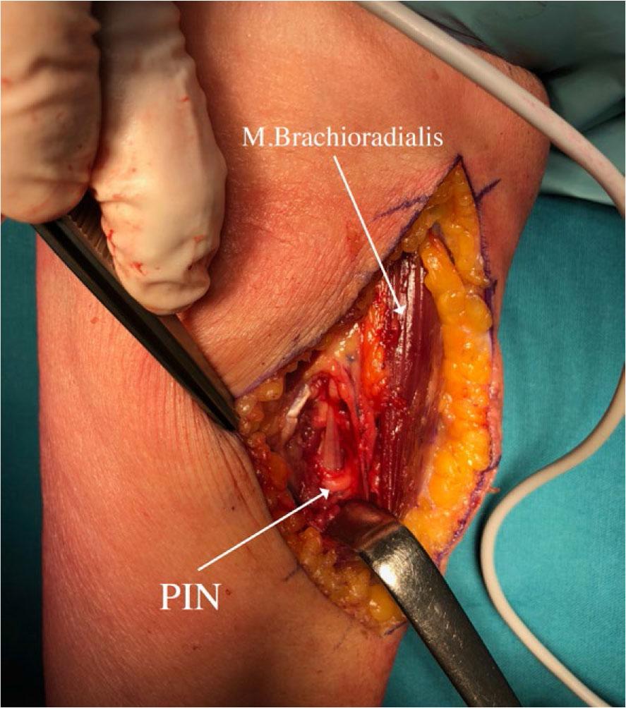 Local situation after lipoma removalPIN = posterior interosseus nerve.