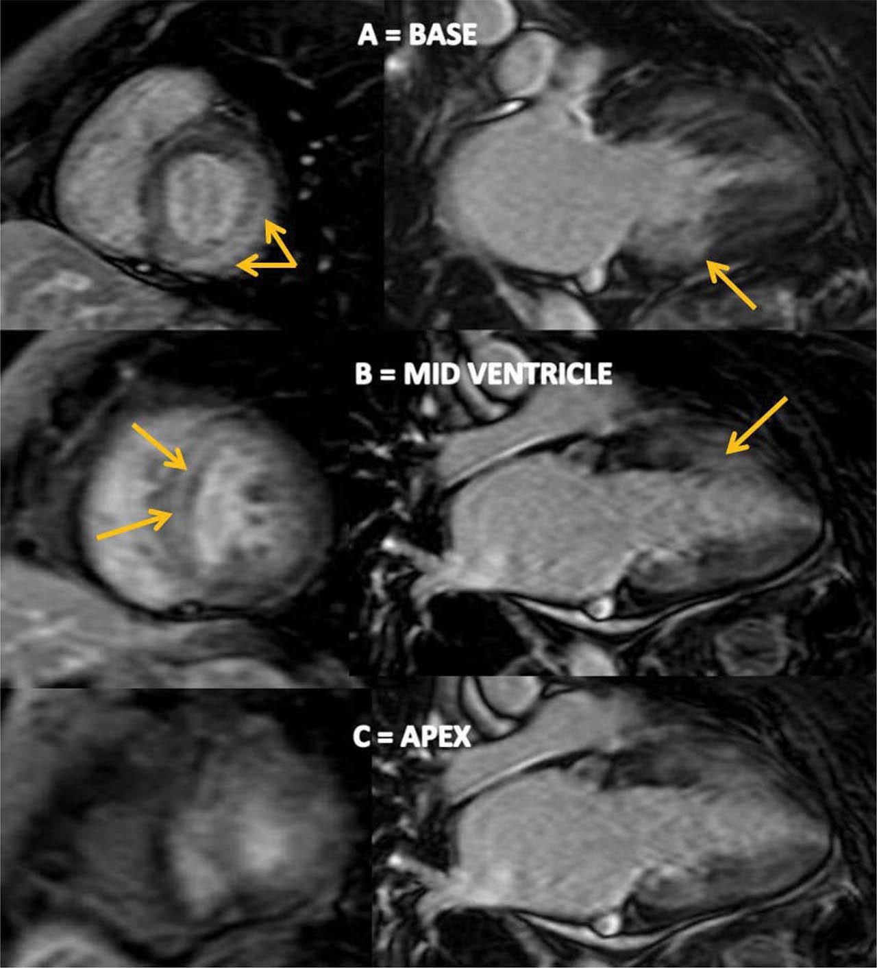 Cardiac magnetic resonance images showing A and B diffuse subendocardial LGE at the base and mid-ventricle in the left ventricle (yellow arrows). C no LGE of the apex. LGE: late-gadolinium enhancement.