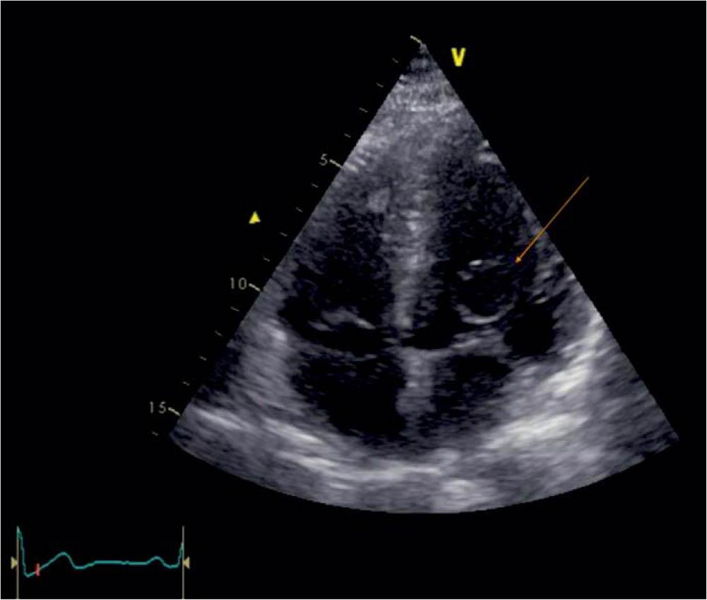 TTE apical 4 chamber, visualization of the blood cyst (arrow) attached to the MV.