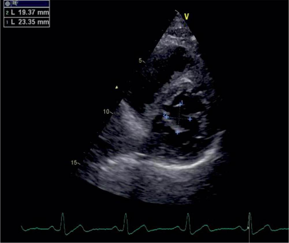 TTE parasternal short axis, visualization and measuring of the blood cyst.