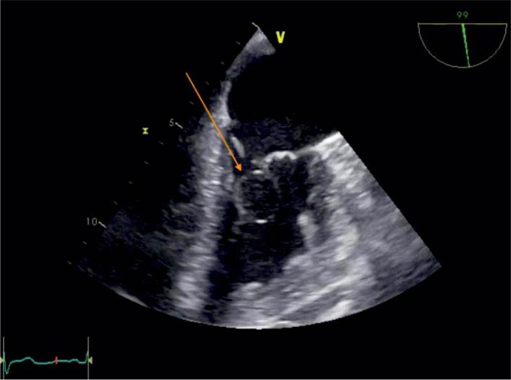 TEE 99 degrees, visualization of the blood cyst (arrow) attached to the MV.