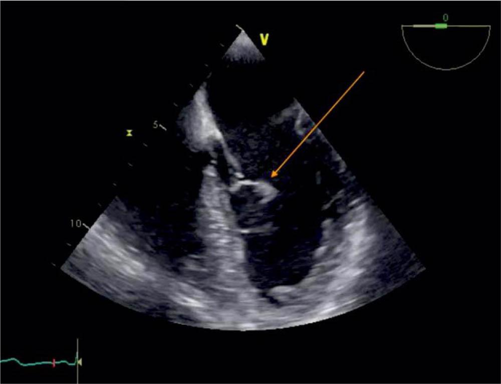 TEE 0 degrees, visualization of the blood cyst (arrow) attached to the AML.