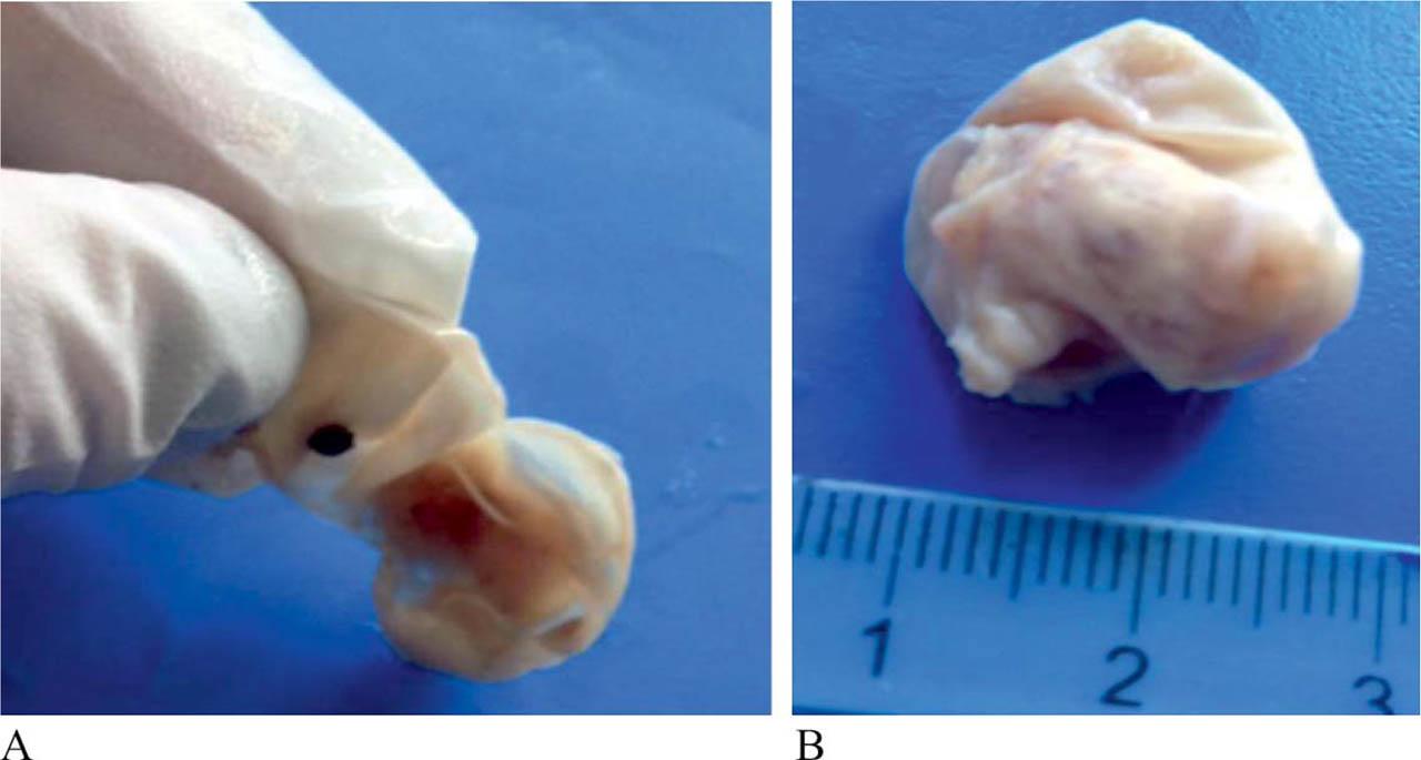 Blood cyst after resection, devoid of its content.