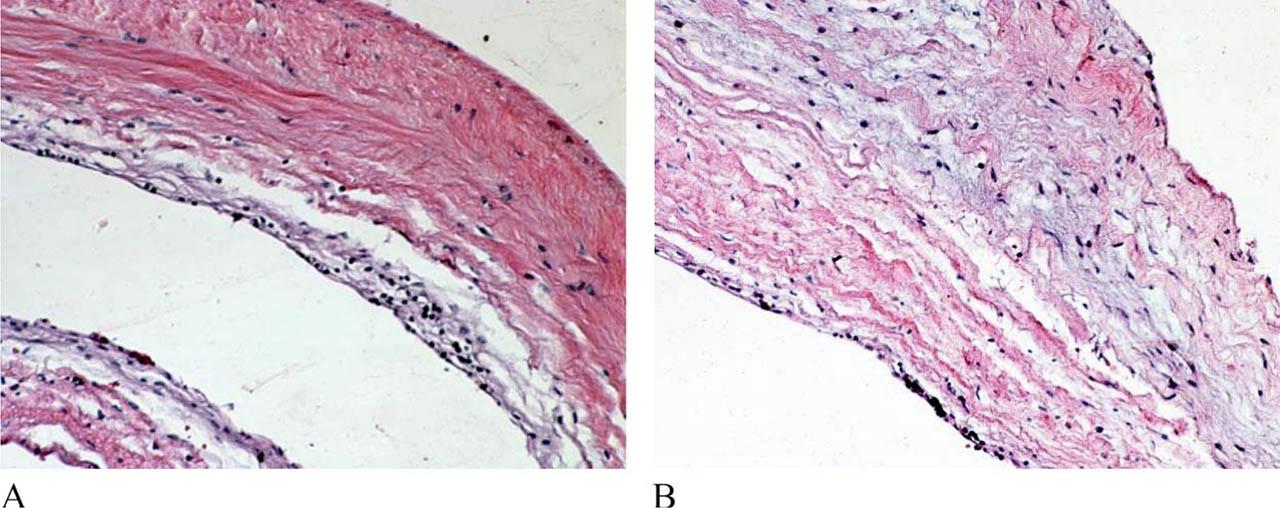 A. Cyst wall composed of dense connective tissue with some lymphocytes. HE x 100. B. Myxoid changes of the cystic wall. HE x 200.