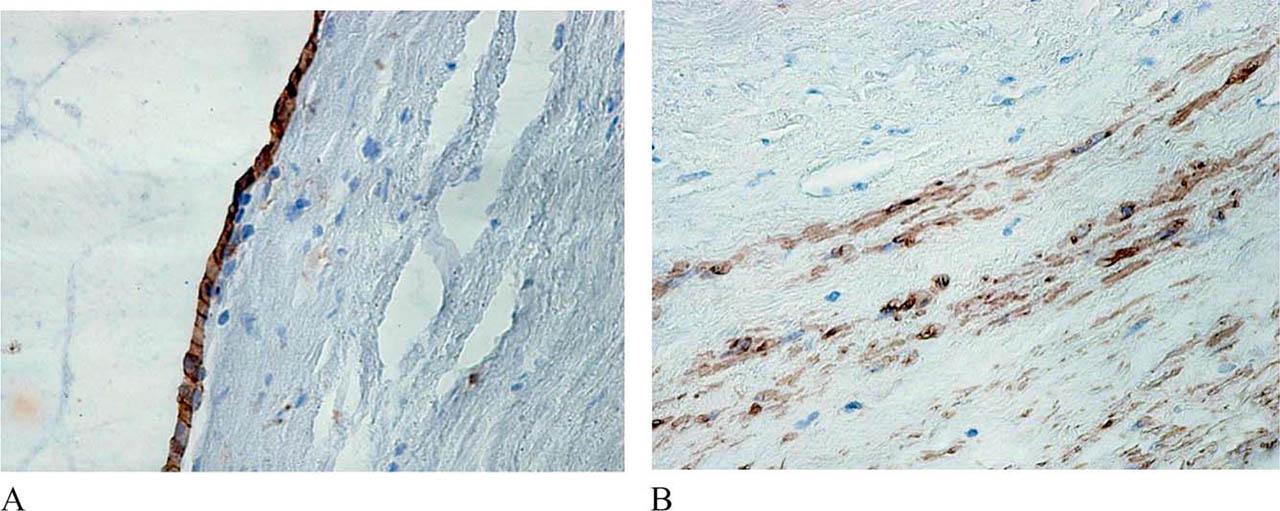 A. Endothelial cells lining the cyst. Anti-CD31, DAB x 400. B. Smooth muscle cells in the cyst wall. Anti-SMA, DAB x 400.