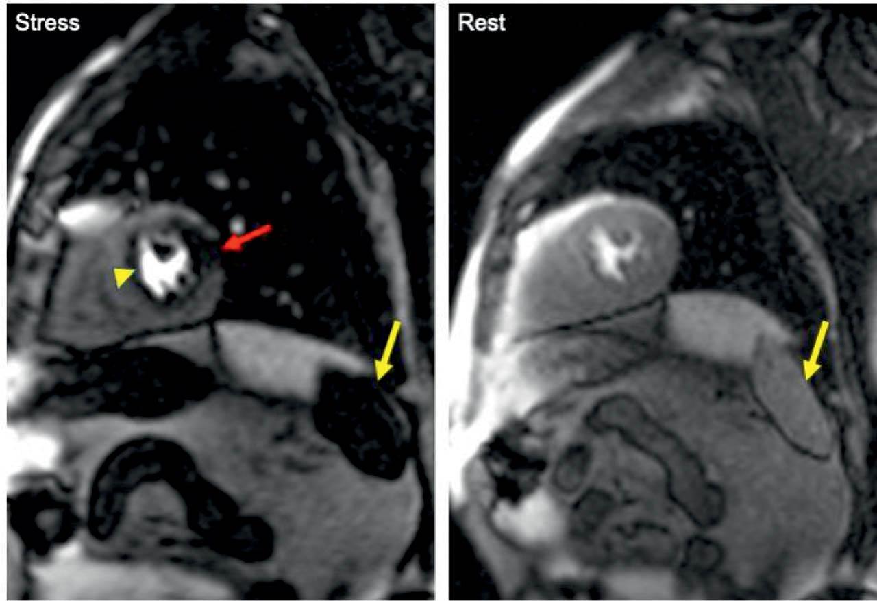 Short-axis mid-ventricular slices acquired during stress and rest, showing the splenic switch-off phenomenon, defined as a visible decrease in splenic signal intensity during adenosine stress as compared to rest (yellow arrow). During adenosine-induced hypotension, the splenic blood flow is reduced presumably due reactive sympathetic vasoconstriction. During stress, a perfusion defect is seen on the lateral wall (red arrow). This defect is no longer seen on rest perfusion acquisition. The yellow arrowhead indicates a dark-rim artifact which is the most common artifact seen in stress perfusion CMR.