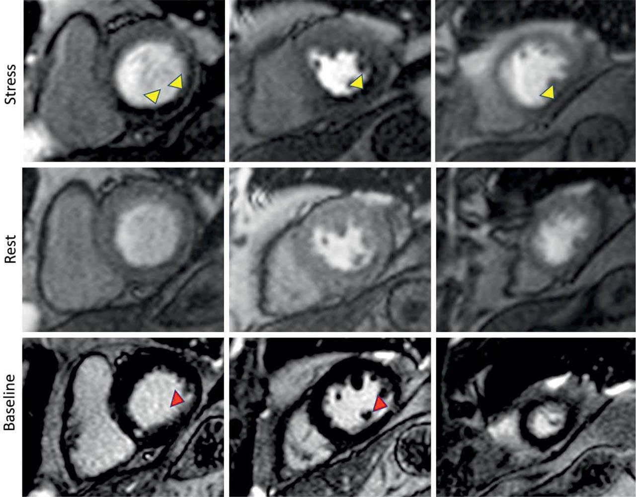 Stress Perfusion CMR in a 61-year-old patient with intermediate lesions on invasive coronary angiography, without a clinical history of myocardial infarction. Perfusion imaging acquired during adequate vasodilator stress (upper row) show a large perfusion defect in the right coronary (RCA) territory (basal infero-septum, inferior and infero-lateral walls, mid inferior and infero-lateral walls and apical inferior segment) (yellow arrowhead). The rest acquisition (middle row) shows no evidence of perfusion defect. Late Gadolinium imaging (lower row) shows a small subendocardial scar (hyperenhancement) in the RCA territory (red arrowheads). Of note, the stress perfusion defect extends well beyond the myocardial scar.