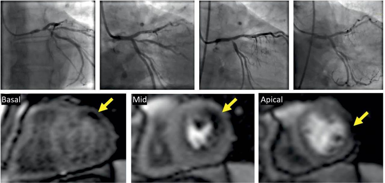 Stress perfusion CMR in a 70-year-old patient with a history of complex PCIs. His initial culprit lesion was a severe left main stenosis for which he was revascularized with a 2-stent technique. After one year, the stent on circumflex artery (Cx) had a severe ostial restenosis with chronic occlusion of the large ramus intermedius (RI). The Cx lesion was dilated with a DES but the RI could not be opened. Basal, mid and apical short axis slices acquired during maximal vasodilatory stress showing a perfusion defect in 3 myocardial segments: basal anterior, mid lateral and apical lateral wall respectively (yellow arrows). The topography of hypoperfused myocardium is compatible with the territory of the occluded intermediate ramus.