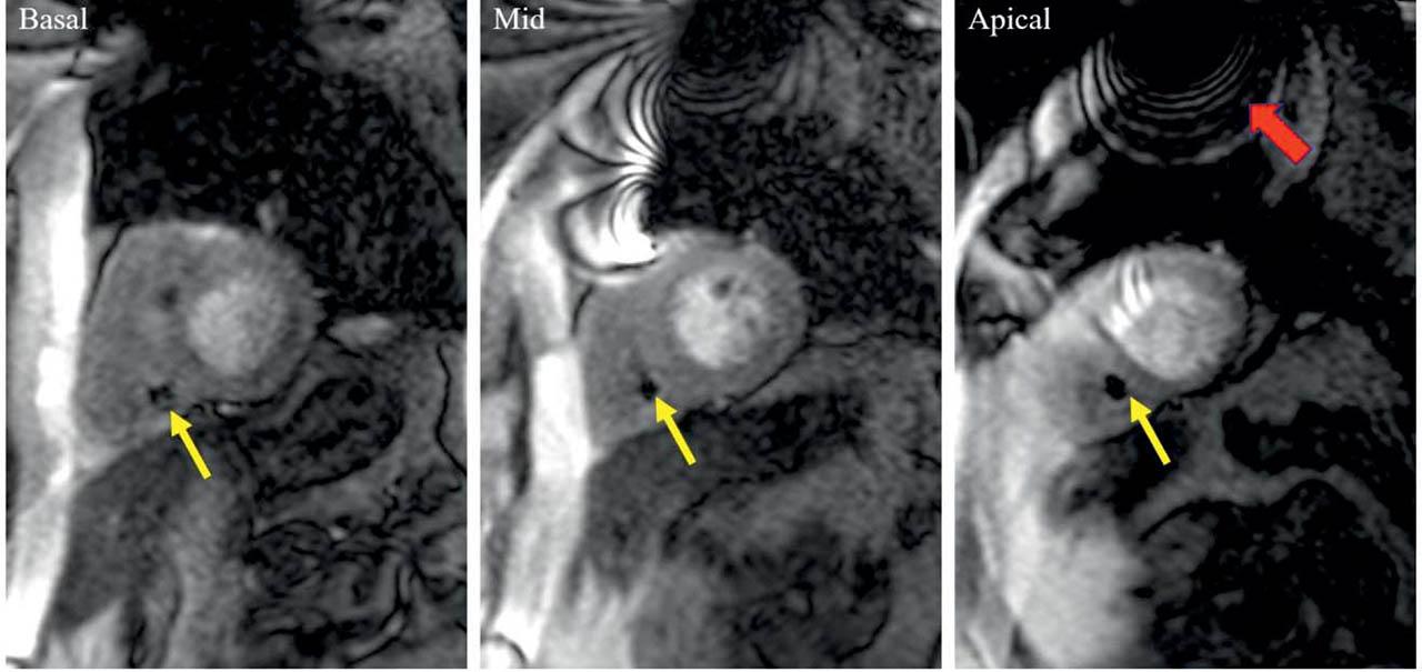 Stress perfusion CMR in a 60-year-old patient with intermediate lesions on invasive coronary angiography, with a dual chamber pacemaker implanted for intermittent AV block. During CMR examination, the pacemaker was set in DOO mode, 80 bpm. Basal, mid and apical short axis slices show the pacemaker right ventricular lead (yellow arrow) which does not induce any metallic artifacts. However, the pulse generator (red arrow), induces a significant artifact which precludes the optimal visualisation of the apical anterior segment only. Overall, the image quality permits reliable interpretation of the stress test.