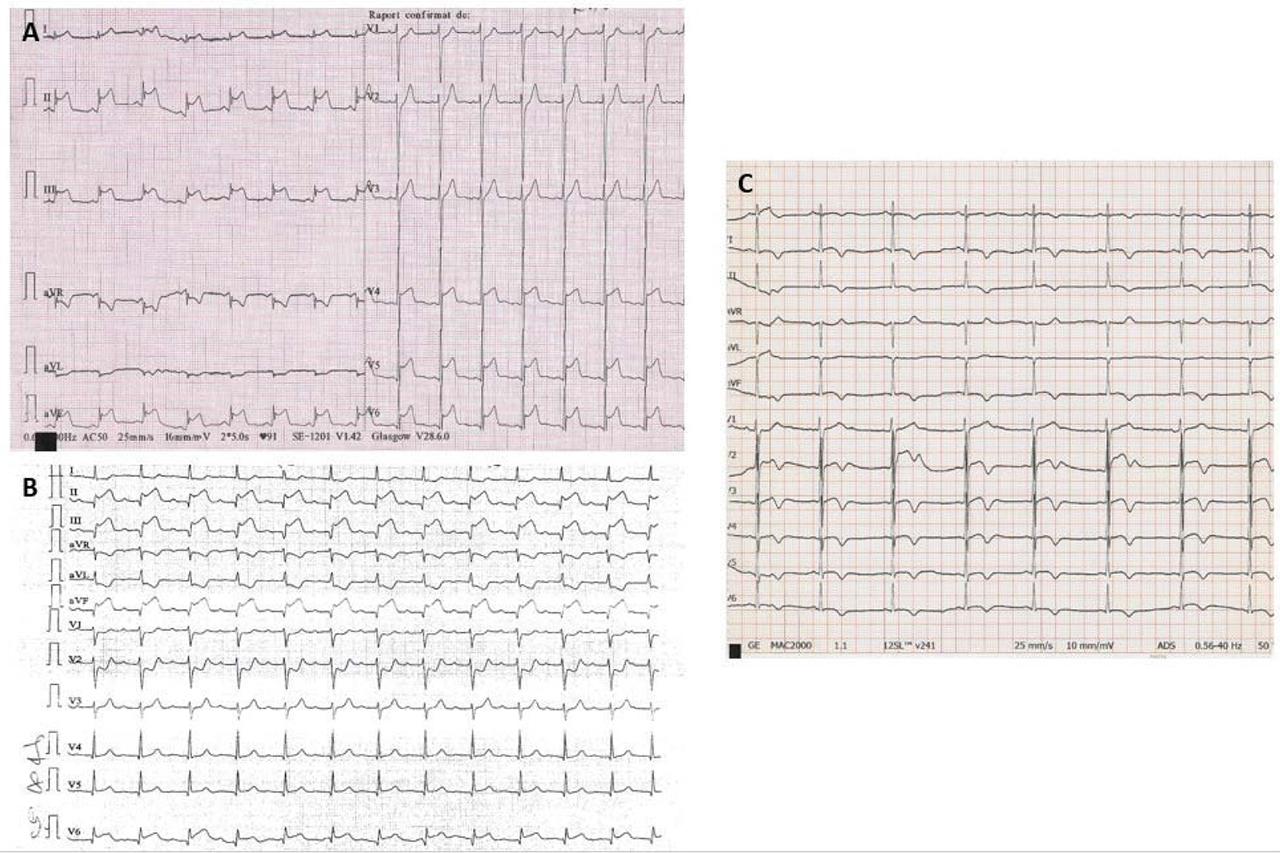 ECG: strip A – at admission to local hospital; strip B – at admission to our hospital; strip C – day 6 after admission to our hospital.
