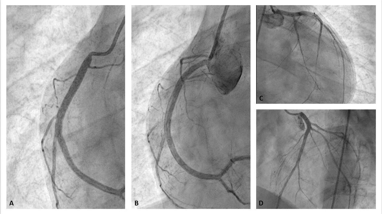 Coronary angiography showing (A) important spasm of right coronary artery which subsided after intracoronary Nitroglycerin administration (B); normal left coronary system (C and D).