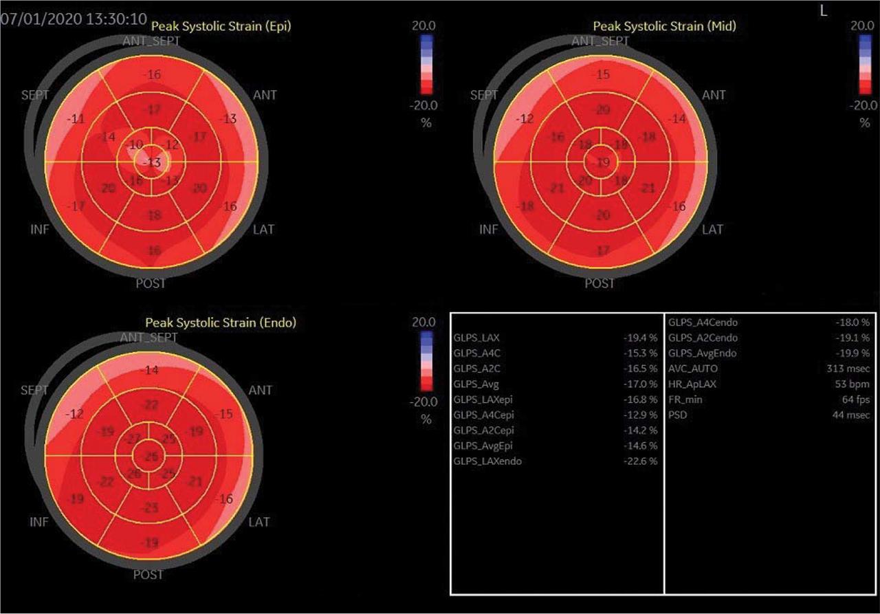 Speckle tracking echocardiography performed 8 days after admission showing decreased global longitudinal strain, especially in the epicardial layer, with a patchy and diffused distribution of reduced strains across all segments.