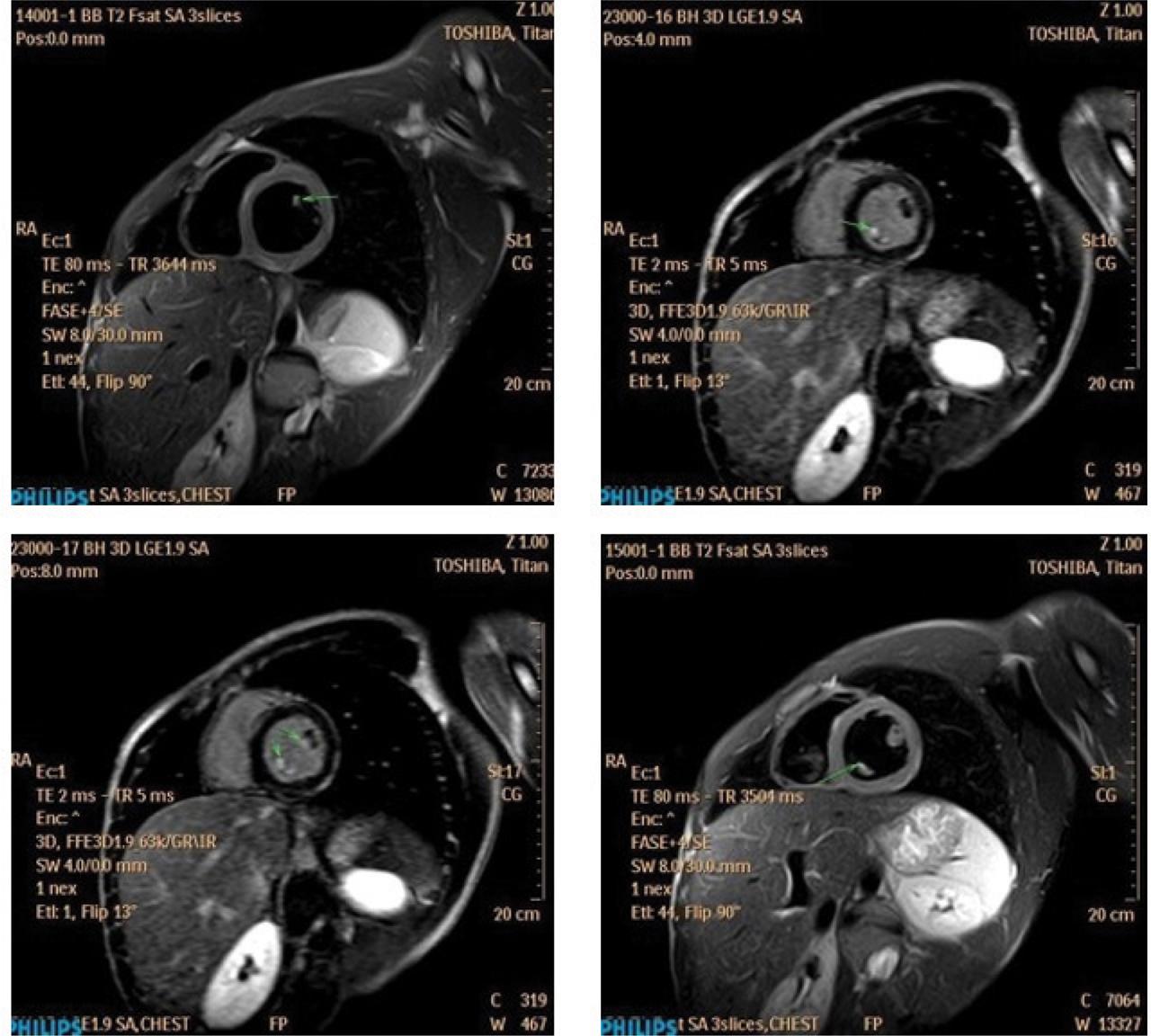 CMR scan done at 14 days. LGE and T2-weighted sequences showing edema at the distal portion of the left ventricular papillary muscles (arrow).
