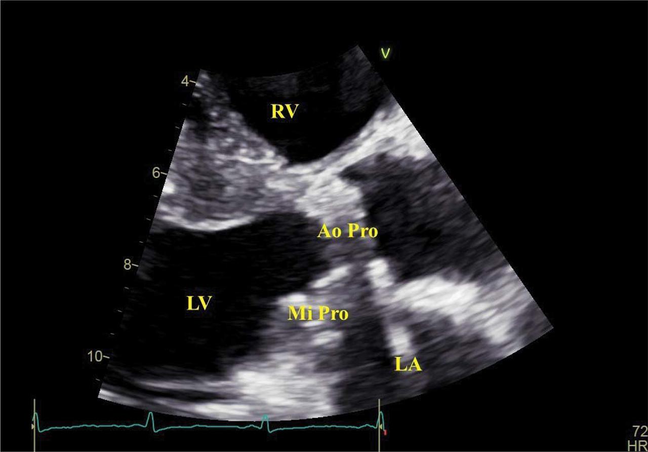 Transthoracic echocardiography, parasternal long axis view, zoom on the aortic and mitral prosthesis. Structural changes of the mitral prosthesis suggestive of possible thrombosis. No significant changes seen on the aortic prosthesis. Ao Pro, aortic prothesis; LA, left atrium; LV, left ventricle; Mi Pro, mitral prosthesis; RV, right ventricle.