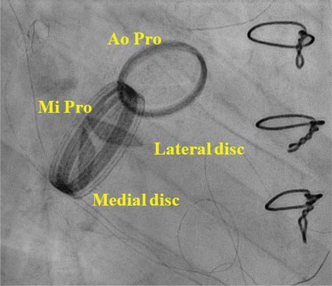 Fluoroscopy showing blocked medial mitral disc. Ao Pro, aortic prosthesis; Mi Pro, mitral prosthesis.