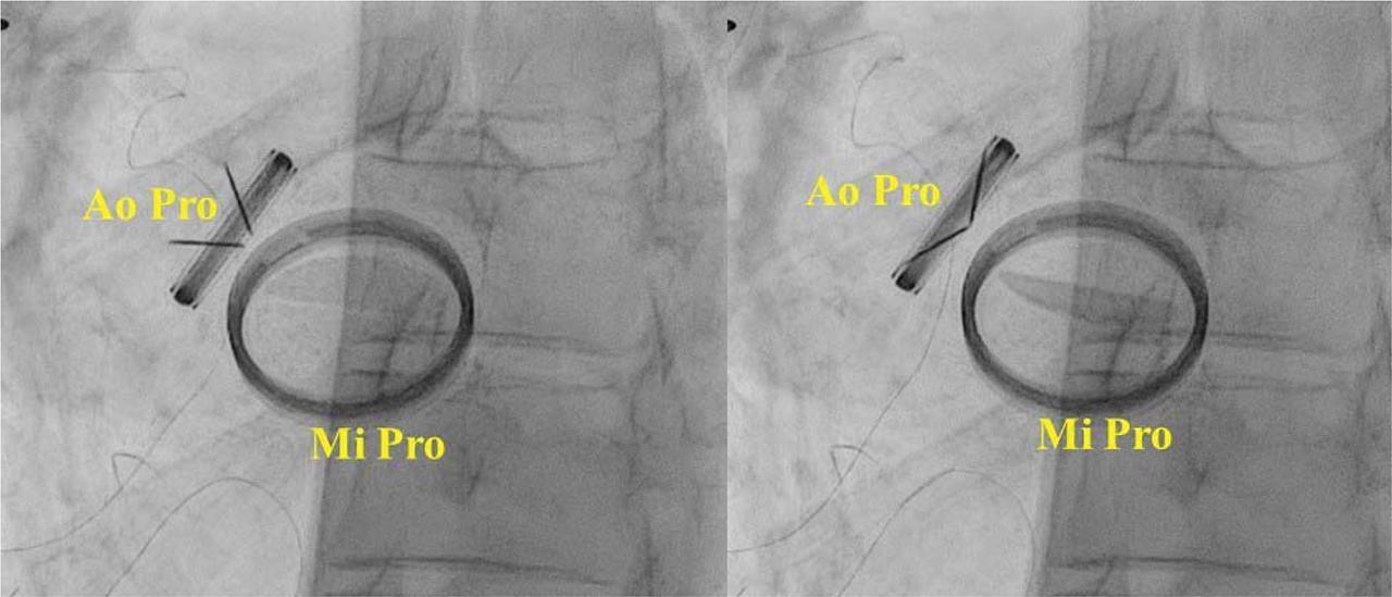Fluoroscopy showing normal opening (left) and closing (right) of both aortic prothesis discs. Ao Pro, aortic prosthesis; Mi Pro, mitral prosthesis.