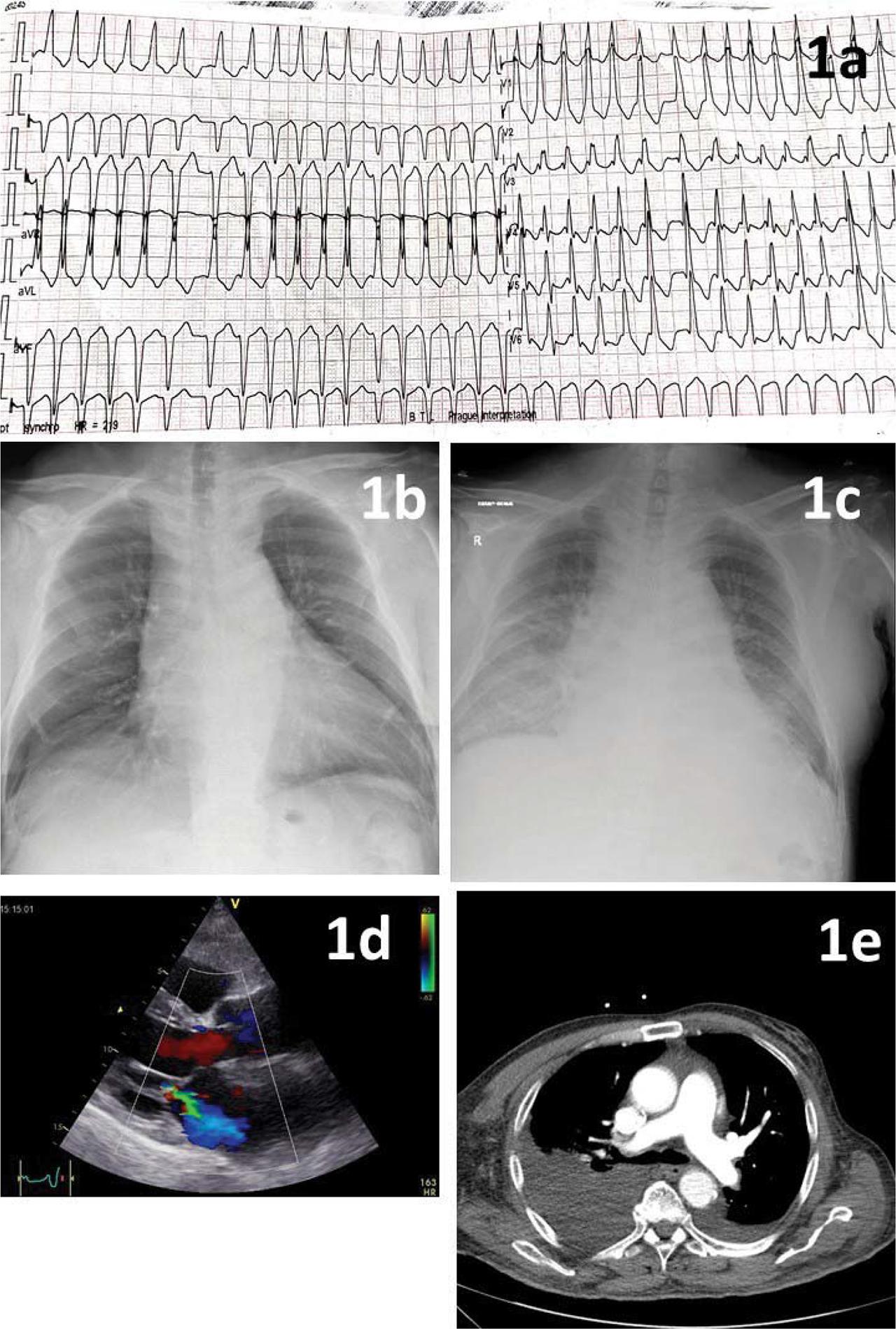 ECG and imaging. 1a – ECG: irregular rhythm (AF), HR ~ 180 bpm, borderline QRS length (120 ms), RBBB pattern, left anterior fascicular block, ST-T segment depression in the anterolateral leads. 1b – CXR 6 months prior – increased cardiac index, no congestion. 1c – CXR at admission – bilateral pulmonary congestion, apical vascular redistribution, and right pleural effusion, 1d – transthoracic echocardiography – moderate functional mitral regurgitation, dilated LA (50 ml/m2), no LVH, mild LV dilation (EDLVD 54 mm), 1e – CT pulmonary angiography – excludes PE, confirms the presence of moderate pleural effusion. Legend: ECG = electrocardiogram, AF = atrial fibrillation, HR = heart rate, RBBB = right bundle branch block, CXR = chest X-ray, LA = left atrium, LVH = left ventricular hypertrophy, LV = left ventricle, CT = computed tomography, PE = pulmonary embolism.