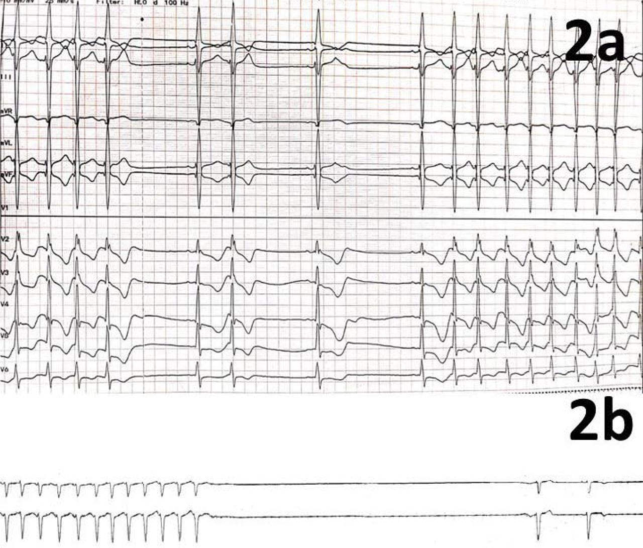 2a - ECG – day 7 – intermittent conversion to SR with a slow HR (40–50 bpm). 2b - ECG Holter – day 8–9 – alternating moderate / high-rate AF and sinus rhythm, several 5–8 second post conversion symptomatic sinusal pauses (7 second pause pictured). Legend: ECG = electrocardiogram, SR = sinus rhythm, HR = heart rate, AF = atrial fibrillation.