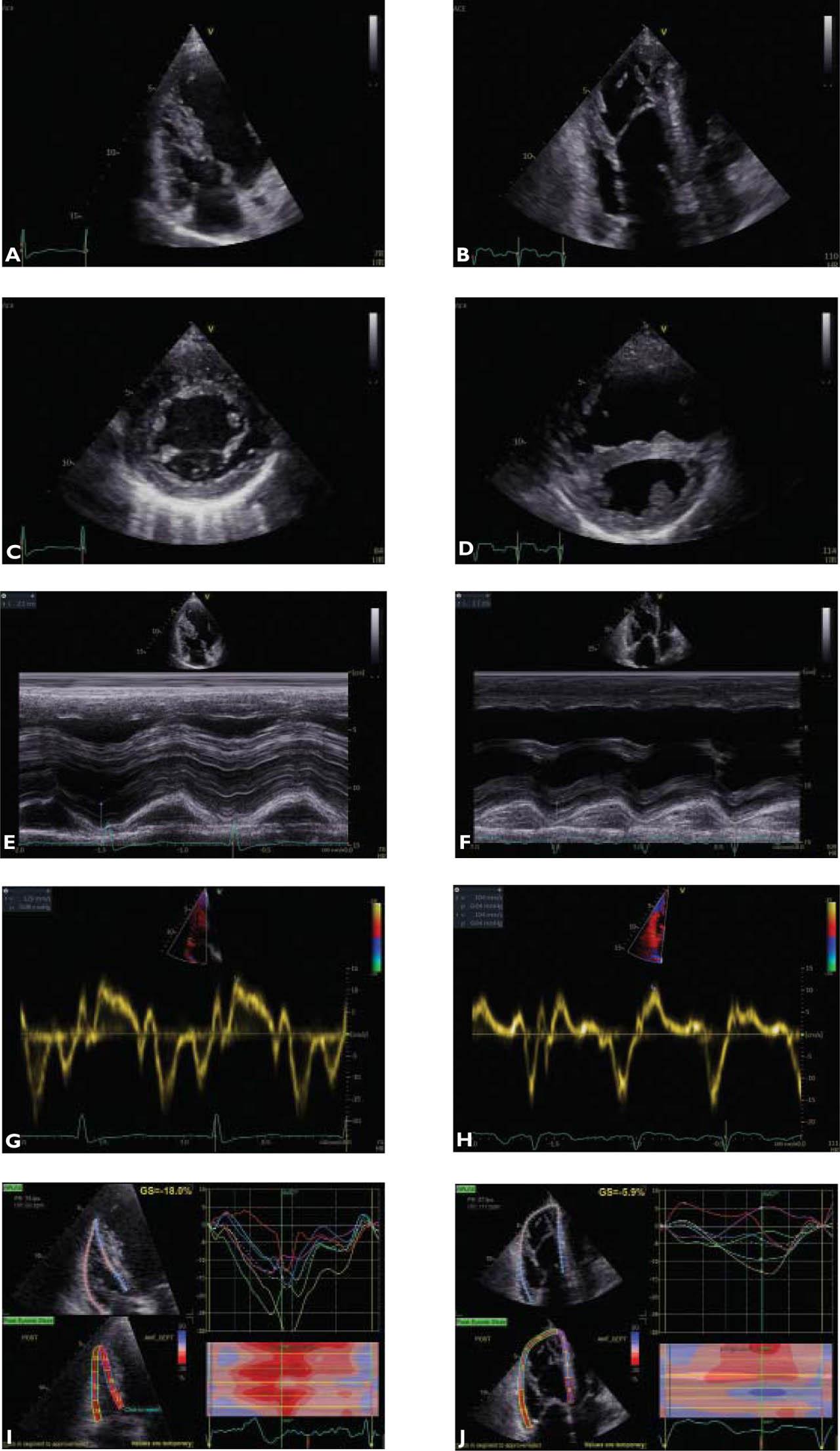 Comparison of echocardiographic characteristics in Eisenmenger syndrome secondary to a non-restrictive ventricular septal defect (left column) vs. non-restrictive atrial septal defect (right column) RV, right ventricle. 1A. Transthoracic echocardiography, apical RV-focused view, 2D examination: adaptive RV hypertrophy with no dilation. 1B. Transthoracic echocardiography, apical RV-focused view, 2D examination: maladaptive RV hypertrophy and significant dilation. 1C. Transthoracic echocardiography, short-axis view, M-mode examination: adaptive RV hypertrophy with no dilation. 1D. Transthoracic echocardiography, short-axis view, M-mode examination: maladaptive RV hypertrophy and significant dilation. 1E. Transthoracic echocardiography, apical RV-focused view, M-mode examination: normal RV longitudinal function (TAPSE 21mm). 1F. Transthoracic echocardiography, apical RV-focused view, M-mode examination: mild RV longitudinal dysfunction (TAPSE 17mm). 1G. Transthoracic echocardiography, apical RV-focused view, TDI: normal RV longitudinal function (S’VD 12.6 cm/s). 1H. Transthoracic echocardiography, apical RV-focused view, TDI: mild RV longitudinal dysfunction (S’VD 10.4 cm/s). 1I. Transthoracic 2D speckle-tracking echocardiography, apical RV-focused view: mildly reduced RV systolic function (6-segments longitudinal strain −18%). 1J. Transthoracic 2D speckle-tracking echocardiography, apical RV-focused view: severe RV systolic dysfunction (6-segments longitudinal strain −5.9%)