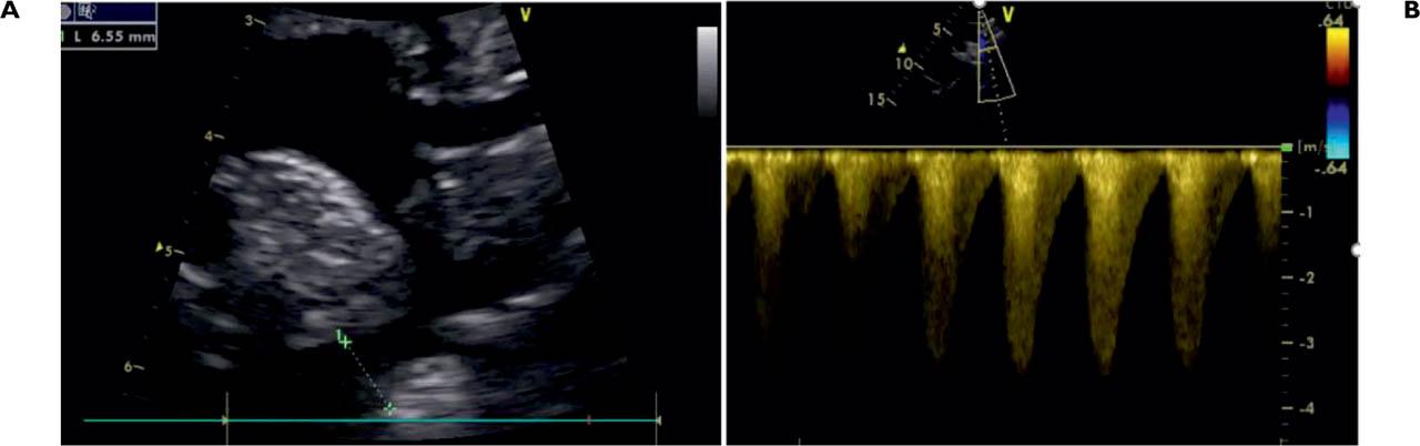 Transthoracic echocardiogram in suprasternal view illustrating narrow aortic isthmus (A) and high blood flow speed – continuous wave Doppler (B) in a patient with coarctation of the aorta.