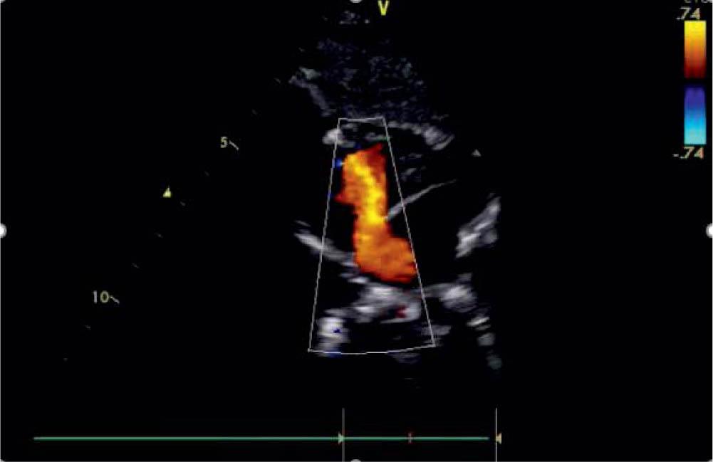Transthoracic echocardiogram in subcostal long-axis view illustrating an ostium secundum atrial septal defect.