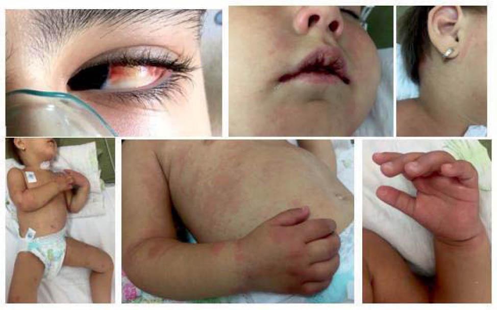 Patients with PIMS and Kawasaki-like clinical features (from left to right, upper and lower row: aseptic conjunctivitis, red and cracked lips, unilateral latero-cervical lymph node, rash, edema of the hands). From our personal collection.