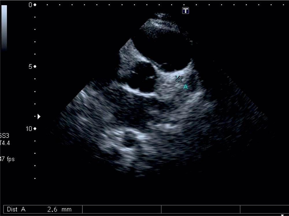 Echocardiography: parasternal short axis through aorta – perivascular brightness with normal coronary arteries.