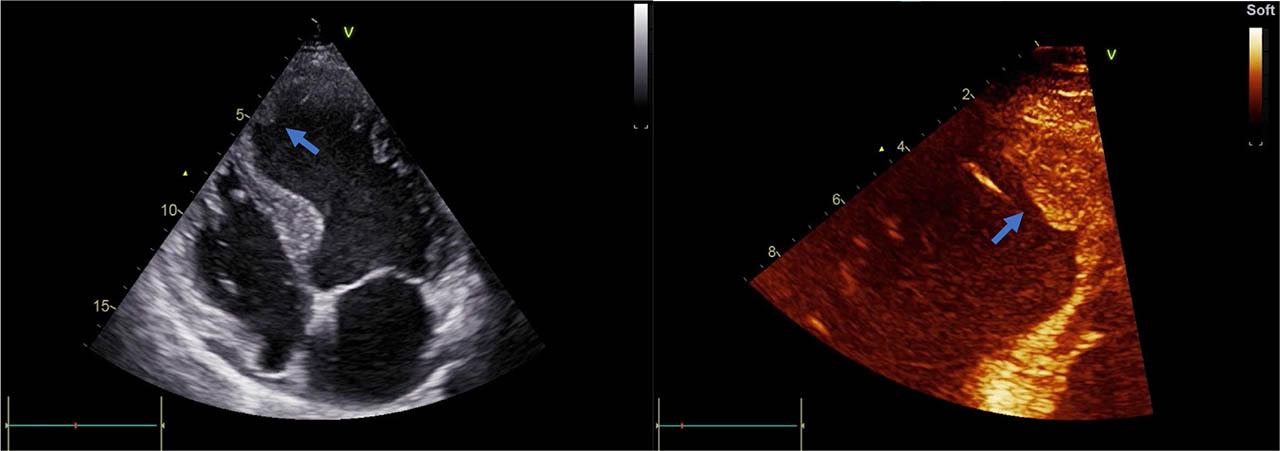 Transthoracic echocardiography of the left ventricle. Thrombus (arrows) attached to the apical septal wall in a patient with ischemic cardiomyopathy.