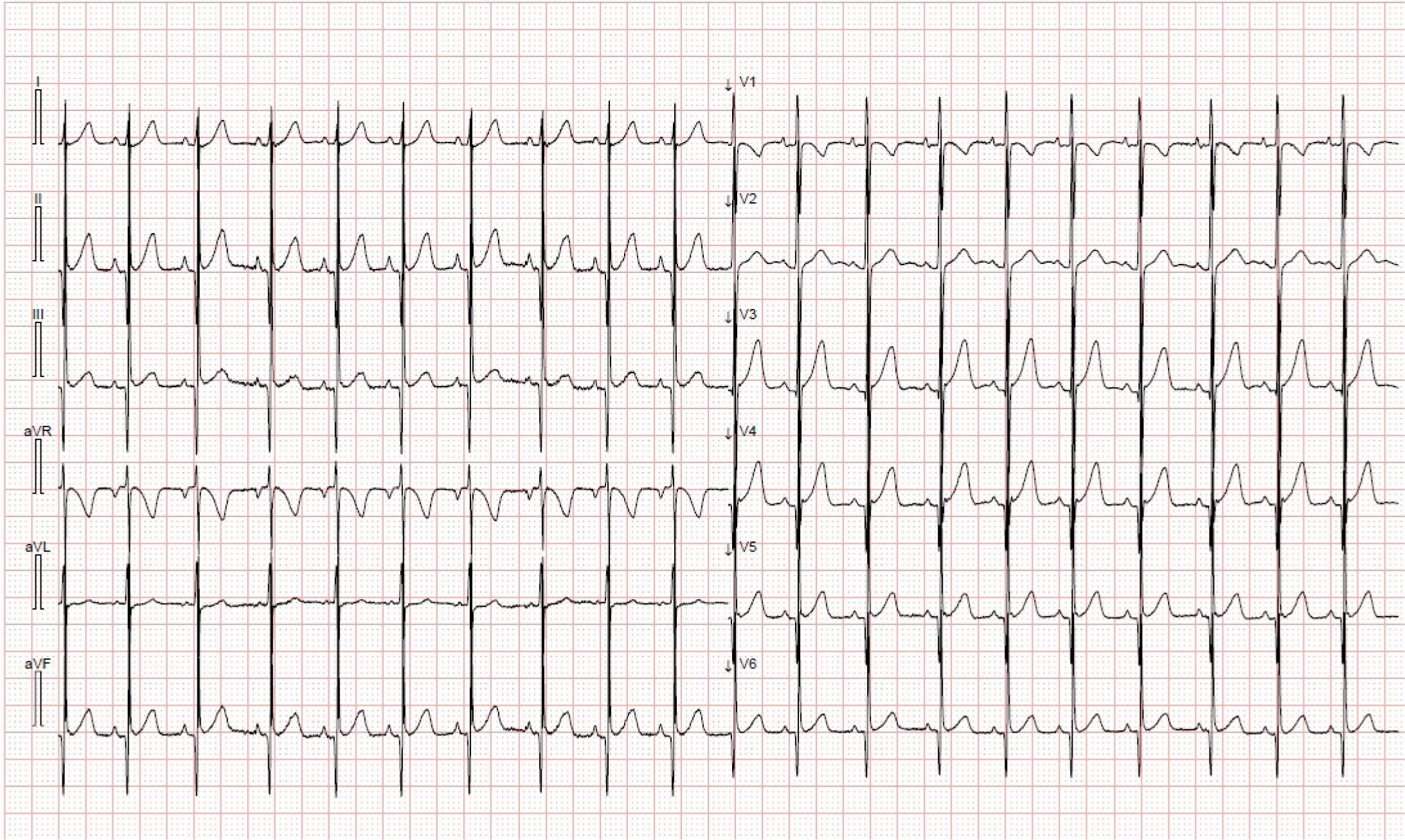 Surface 12-lead ECG depicting sinus tachycardia, with a normal repolarization pattern.