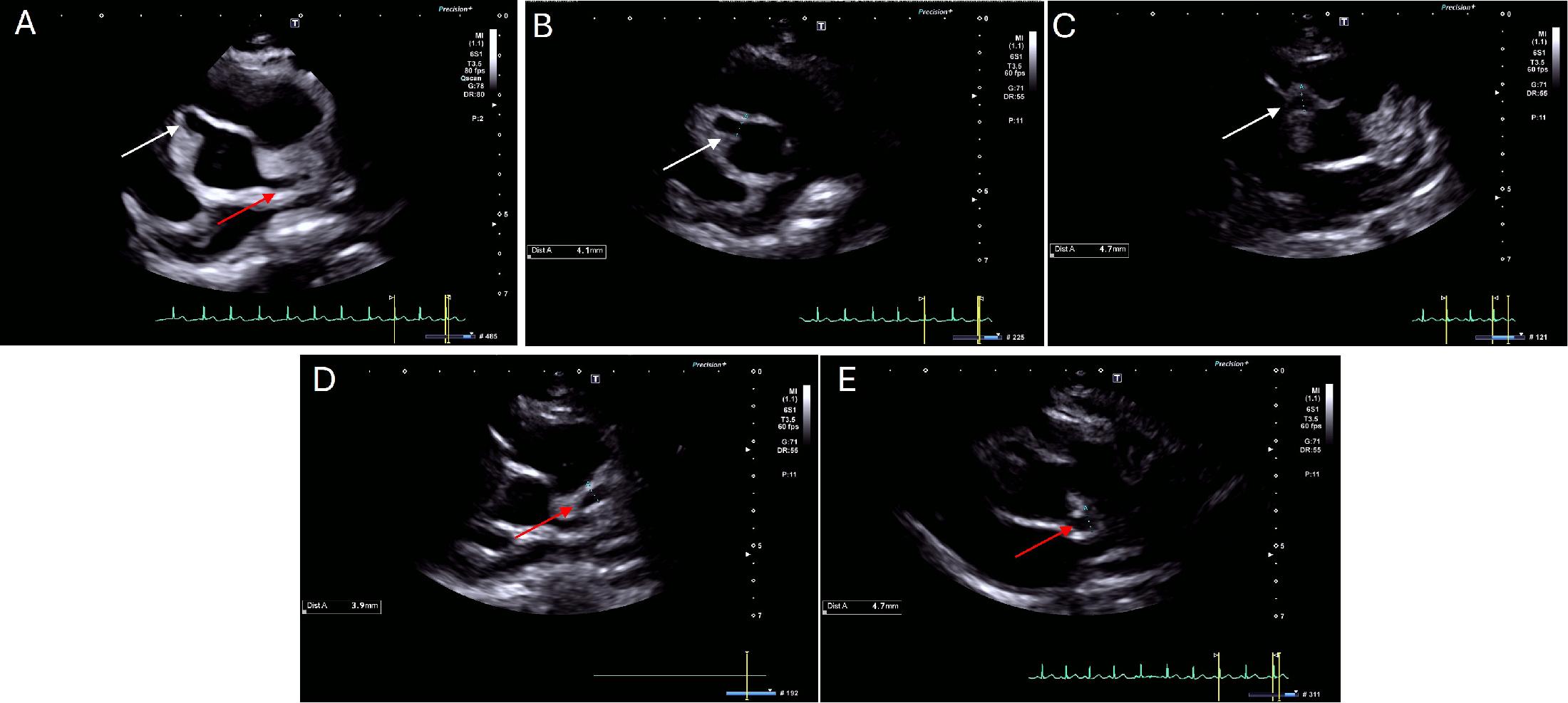 Transthoracic echocardiography in the parasternal short-axis view showing a right coronary artery aneurysm (Panel A, white arrow) and a left main coronary artery aneurysm (Panel A, red arrow). The proximal portion of the right coronary artery (Panel B, white arrow) has a diameter of 4.1 mm (Z-score +7.4), while the distal portion of the right coronary artery (Panel C, white arrow) has a diameter of 4.7 mm (Z-score +7.8). The left main coronary artery bifurcation (Panel D, red arrow) measured 3.9 mm (Z-score +4.9), while the proximal left anterior descending artery (Panel E, red arrow) measured 4.7 mm (Z-score +8.1).