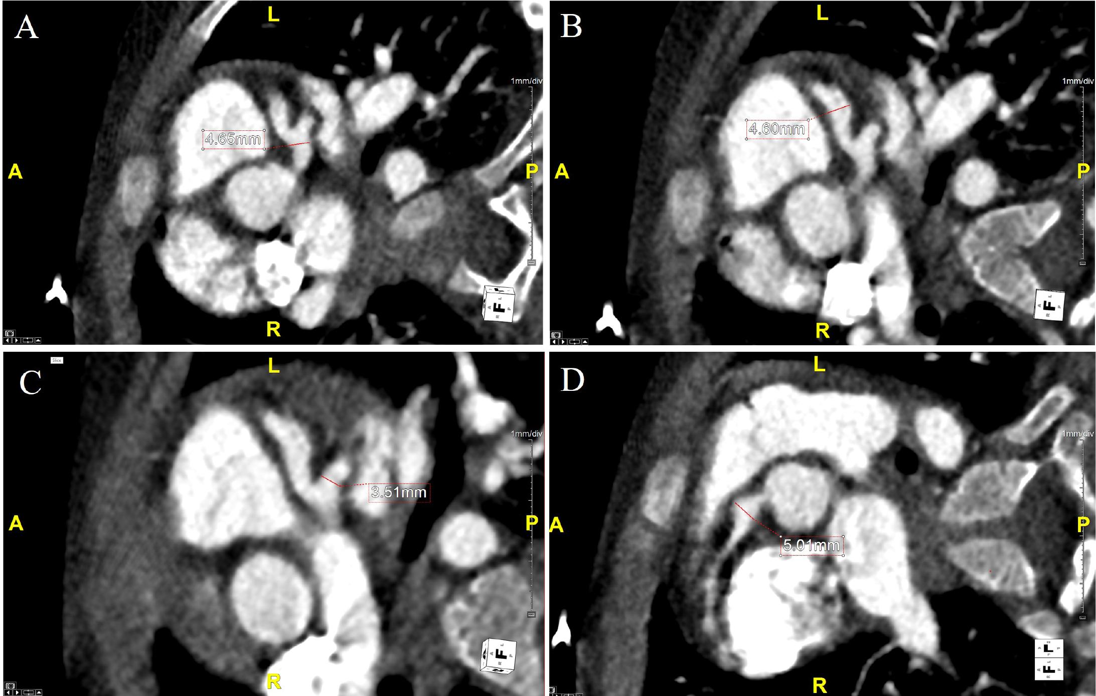 Cardiac computed tomography showing axial plane after multiplanar reconstruction of the left main coronary artery (Panel A) with a maximum diameter of 4.6 mm (Z-score +5.3); the left anterior descending artery (Panel B) with a diameter of 4.6 mm (Z-score +10.0); the circumflex artery with a diameter of 3.5 mm; The right coronary artery in axial reconstruction (Panel D) depicts a proximal diameter of 5 mm (Z-score +9.0).